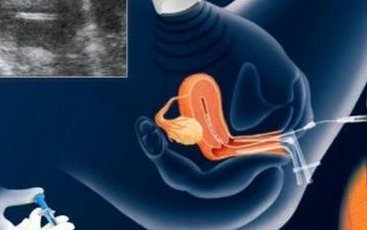 北京试管婴儿全程所需时间及步骤详解